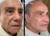 aos-91-anos,-stenio-garcia-exibe-resultado-de-harmonizacao-facial;-veja-antes-e-depois